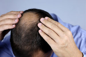 hair loss treatment