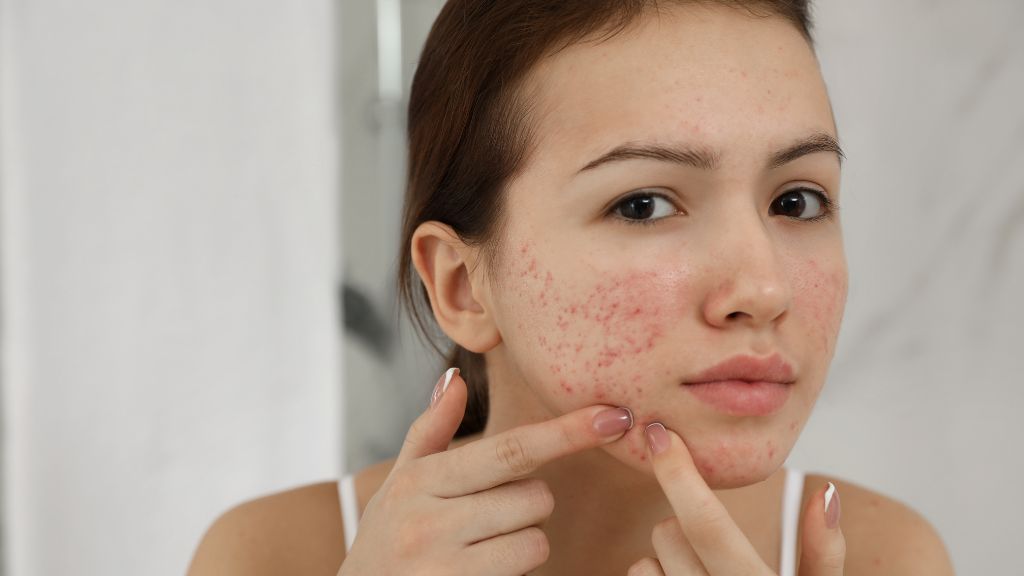 prescription acne treatments